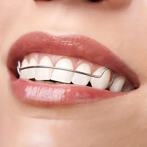 Braces removal before